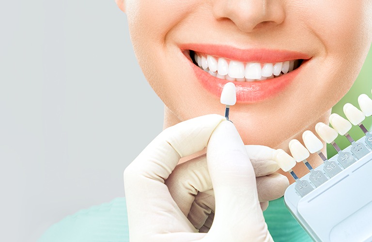 Cosmetic Smile Makeovers