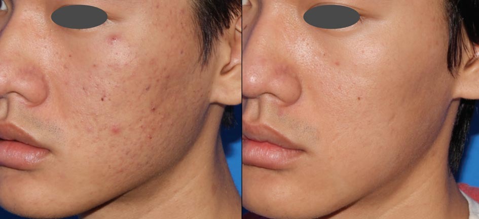 Microneedling