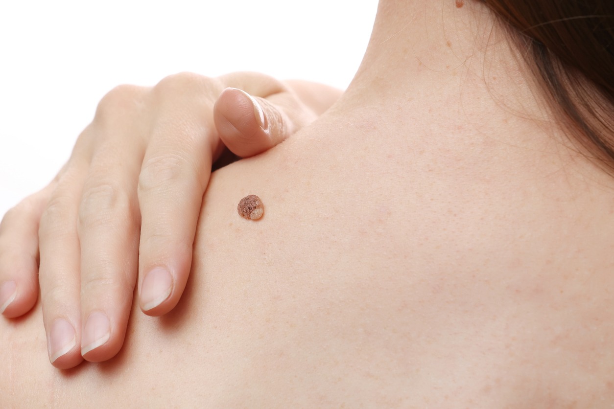 Skin Tag Removal